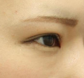 20代女性のタレ目・でか目形成 Before 症例写真