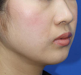 20代女性の顔の脂肪吸引 After 症例写真