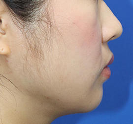 20代女性の顔の脂肪吸引  After 症例写真