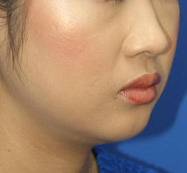 20代女性の顔の脂肪吸引 Before 症例写真