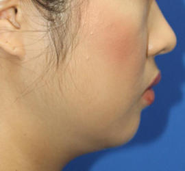 20代女性の顔の脂肪吸引  Before 症例写真