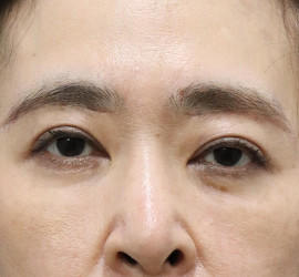 40代女性の眉下切開法 After 症例写真