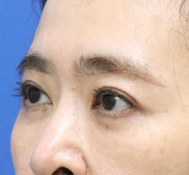 40代女性の眉下切開法 After 症例写真