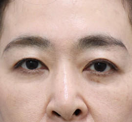 40代女性の眉下切開法 Before 症例写真