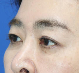 40代女性の眉下切開法 Before 症例写真