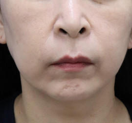 40代女性の肌再生高純度脂肪注入（脂肪移植） After 症例写真