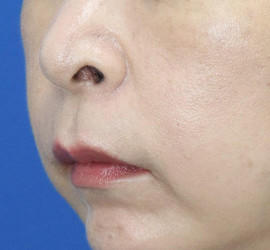 40代女性の肌再生高純度脂肪注入（脂肪移植） After 症例写真