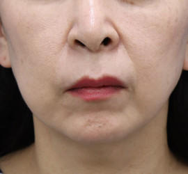 40代女性の肌再生高純度脂肪注入（脂肪移植） Before 症例写真