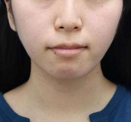 20代女性の顔の脂肪吸引  After 症例写真
