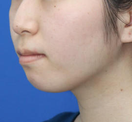 20代女性の顔の脂肪吸引 After 症例写真