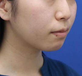 20代女性の顔の脂肪吸引  After 症例写真