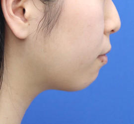 20代女性の顔の脂肪吸引  After 症例写真