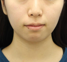 20代女性の顔の脂肪吸引  Before 症例写真