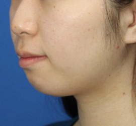 20代女性の顔の脂肪吸引 Before 症例写真