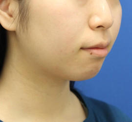 20代女性の顔の脂肪吸引  Before 症例写真