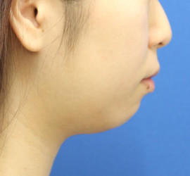 20代女性の顔の脂肪吸引  Before 症例写真