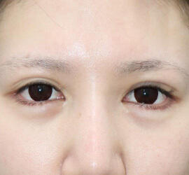 20代女性の二重整形・目元の整形 After 症例写真
