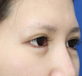 20代女性のタレ目・でか目形成 After 症例写真