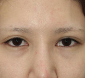 20代女性の二重整形・目元の整形 Before 症例写真