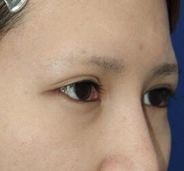 20代女性のタレ目・でか目形成 Before 症例写真