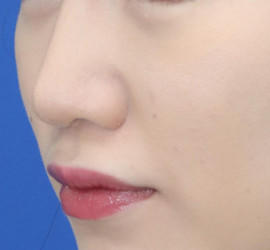 20代女性の耳介軟骨移植 After 症例写真