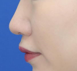 20代女性の耳介軟骨移植 After 症例写真