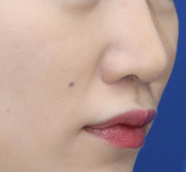 20代女性の耳介軟骨移植 After 症例写真