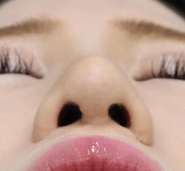 20代女性の耳介軟骨移植 After 症例写真