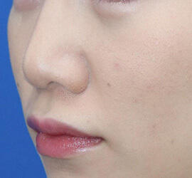 20代女性の耳介軟骨移植 Before 症例写真