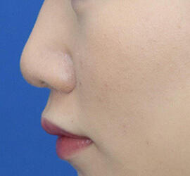 20代女性の耳介軟骨移植 Before 症例写真