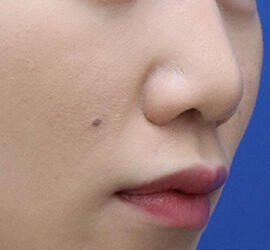 20代女性の耳介軟骨移植 Before 症例写真