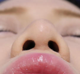 20代女性の耳介軟骨移植 Before 症例写真