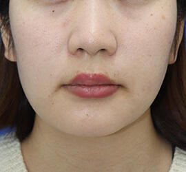 20代女性の顔の脂肪吸引  After 症例写真