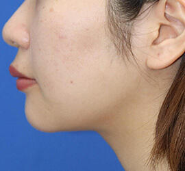 20代女性の顔の脂肪吸引  After 症例写真