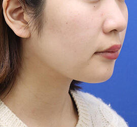 20代女性の顔の脂肪吸引  After 症例写真