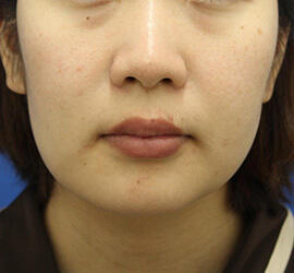 20代女性の顔の脂肪吸引  Before 症例写真