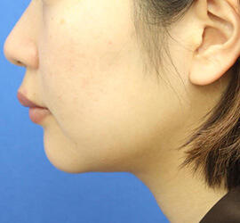 20代女性の顔の脂肪吸引  Before 症例写真