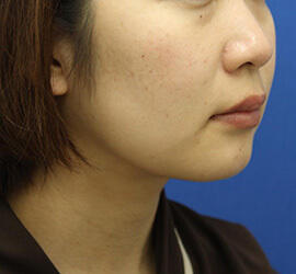 20代女性の顔の脂肪吸引  Before 症例写真
