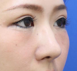 30代女性の耳介軟骨移植 After 症例写真