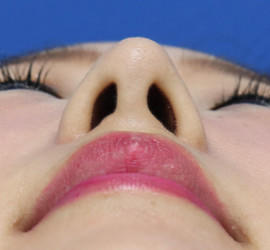 30代女性の耳介軟骨移植 After 症例写真