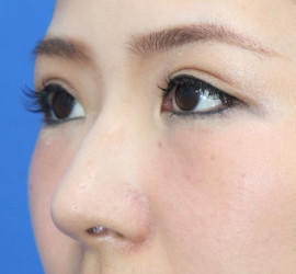 30代女性の鼻の整形 After 症例写真