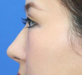 30代女性の耳介軟骨移植 After 症例写真