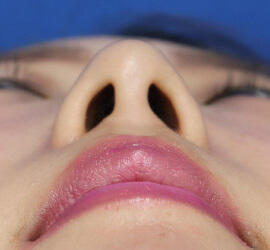 30代女性の耳介軟骨移植 Before 症例写真