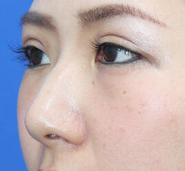 30代女性の鼻の整形 Before 症例写真