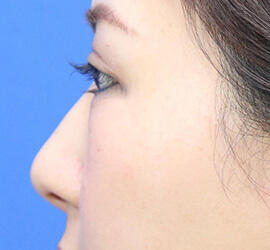 30代女性の耳介軟骨移植 Before 症例写真