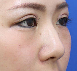 30代女性の耳介軟骨移植 Before 症例写真