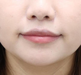 20代女性の人中短縮（リップリフト） After 症例写真