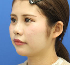 20代女性の人中短縮（リップリフト） After 症例写真