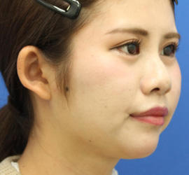 20代女性の人中短縮（リップリフト） After 症例写真