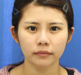 20代女性の人中短縮(リップリフト) Before 症例写真
